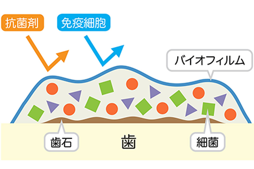 蟹江町（愛知県）の歯医者、あじさいデンタルクリニックの予防歯科