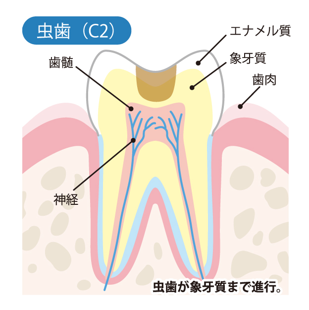 蟹江町（愛知県）の歯医者、あじさいデンタルクリニックでむし歯治療