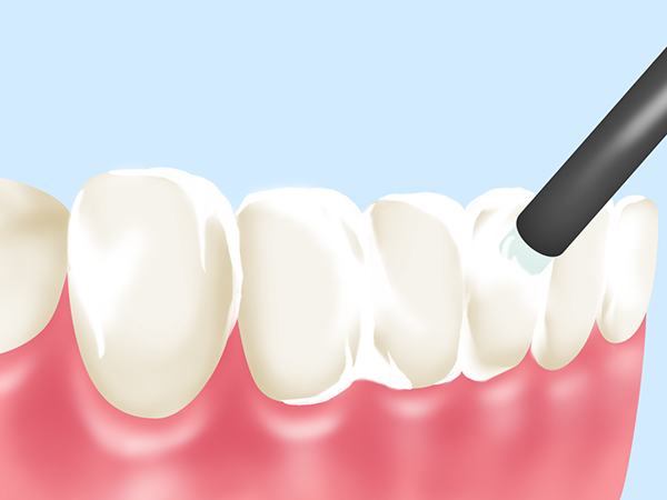 蟹江町（愛知県）の歯医者、あじさいデンタルクリニックのフッ素塗布